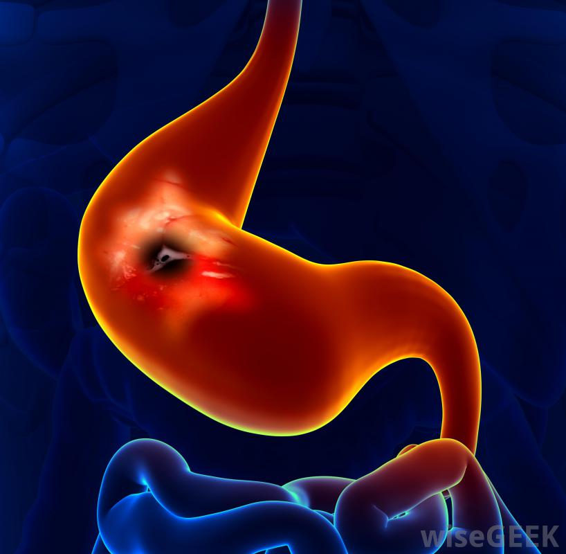 Úlcera Gastroduodenal