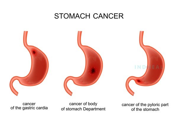 What causes stomach cancer?