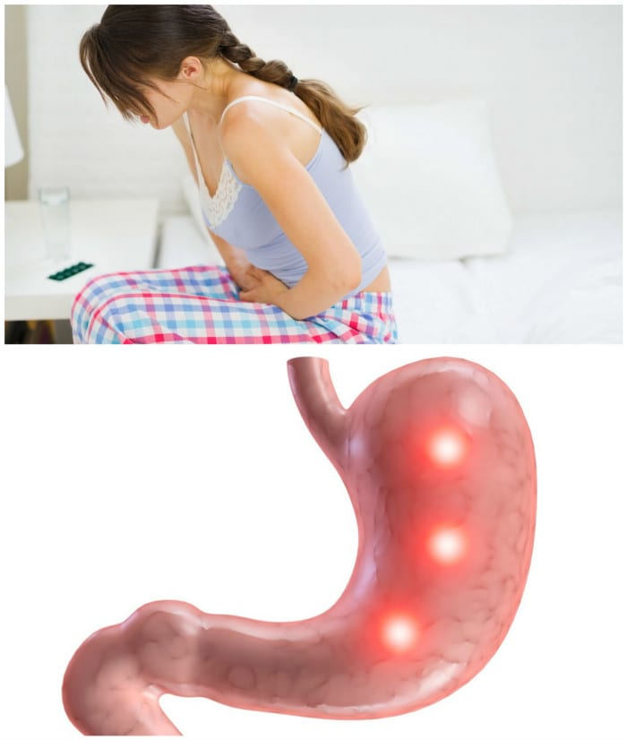 8 Critical Signs That You Have Stomach Ulcers And What To ...