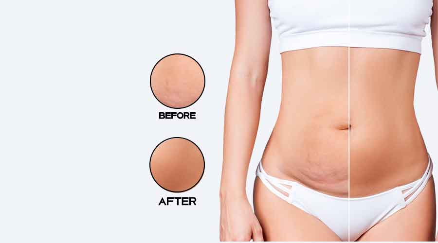 How much does stomach liposuction cost?