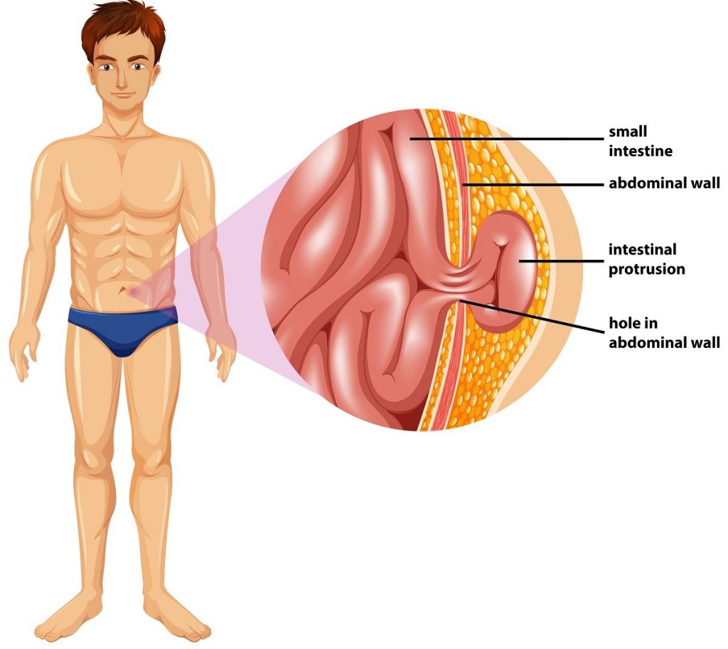 How to Get Rid of Hernia in Hyderabad