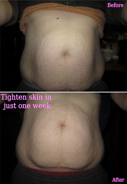 I will if you will: Tighten lose skin in just one week ...