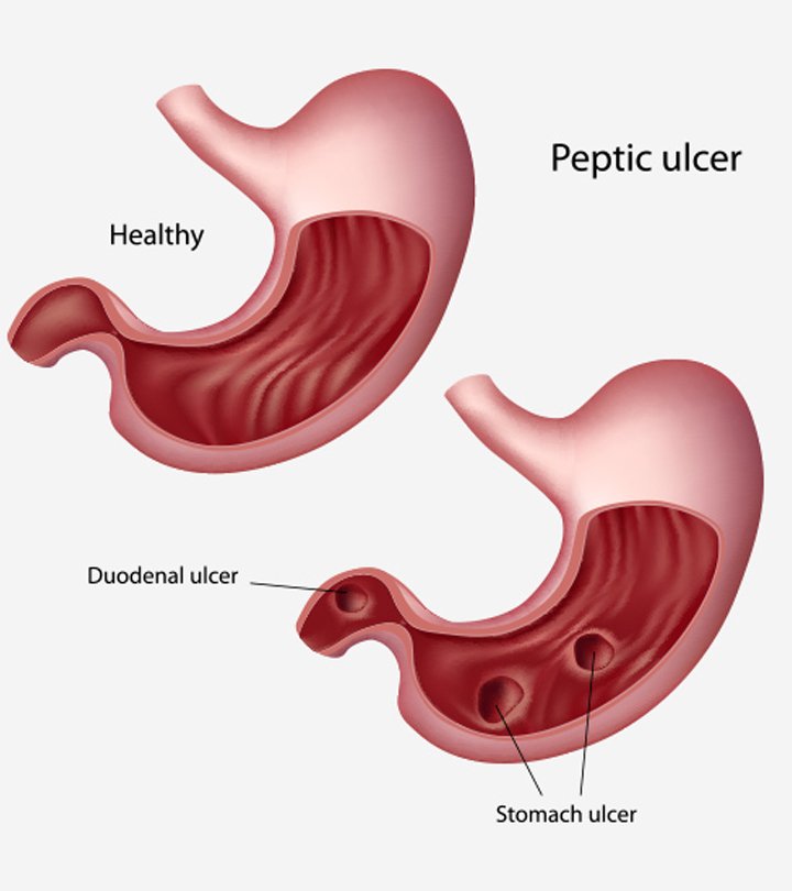 Symptoms Of Stomach Ulcer In Pregnancy