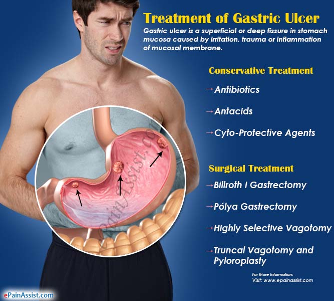 Treatment of Gastric Ulcer