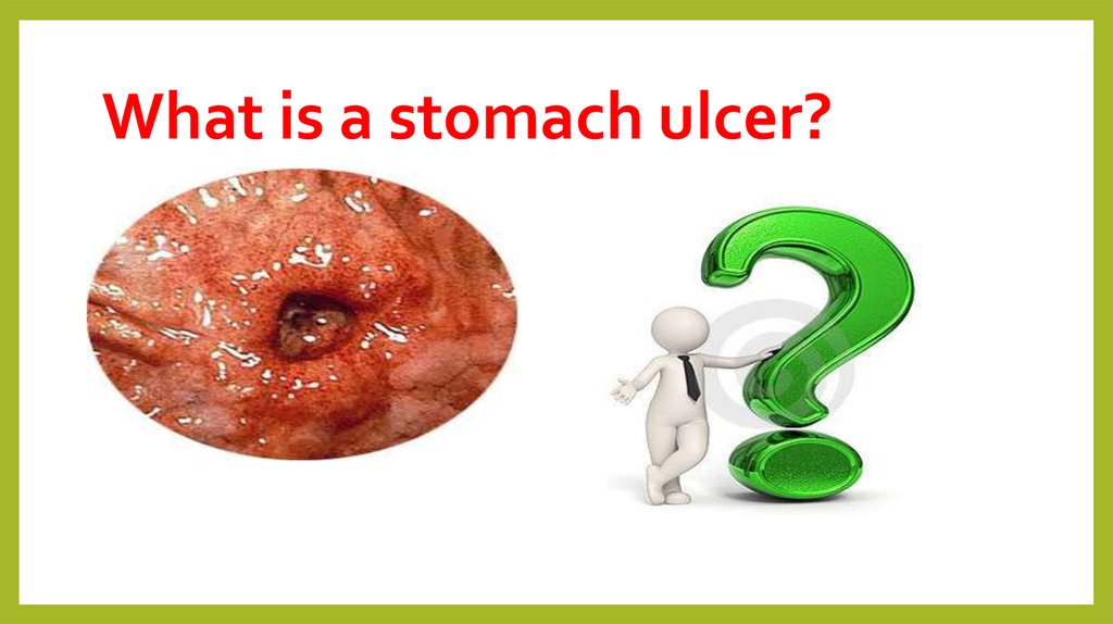 What is a stomach ulcer