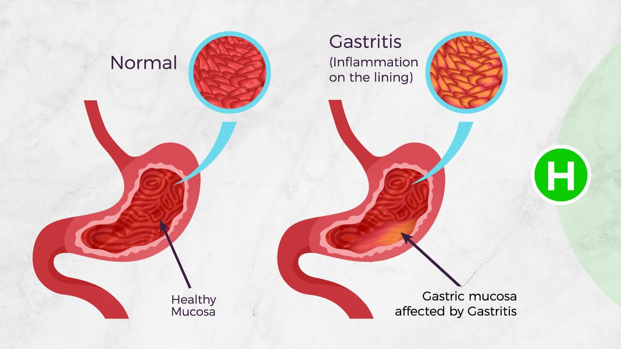 Causes Of Gastritis And How To Deal With It
