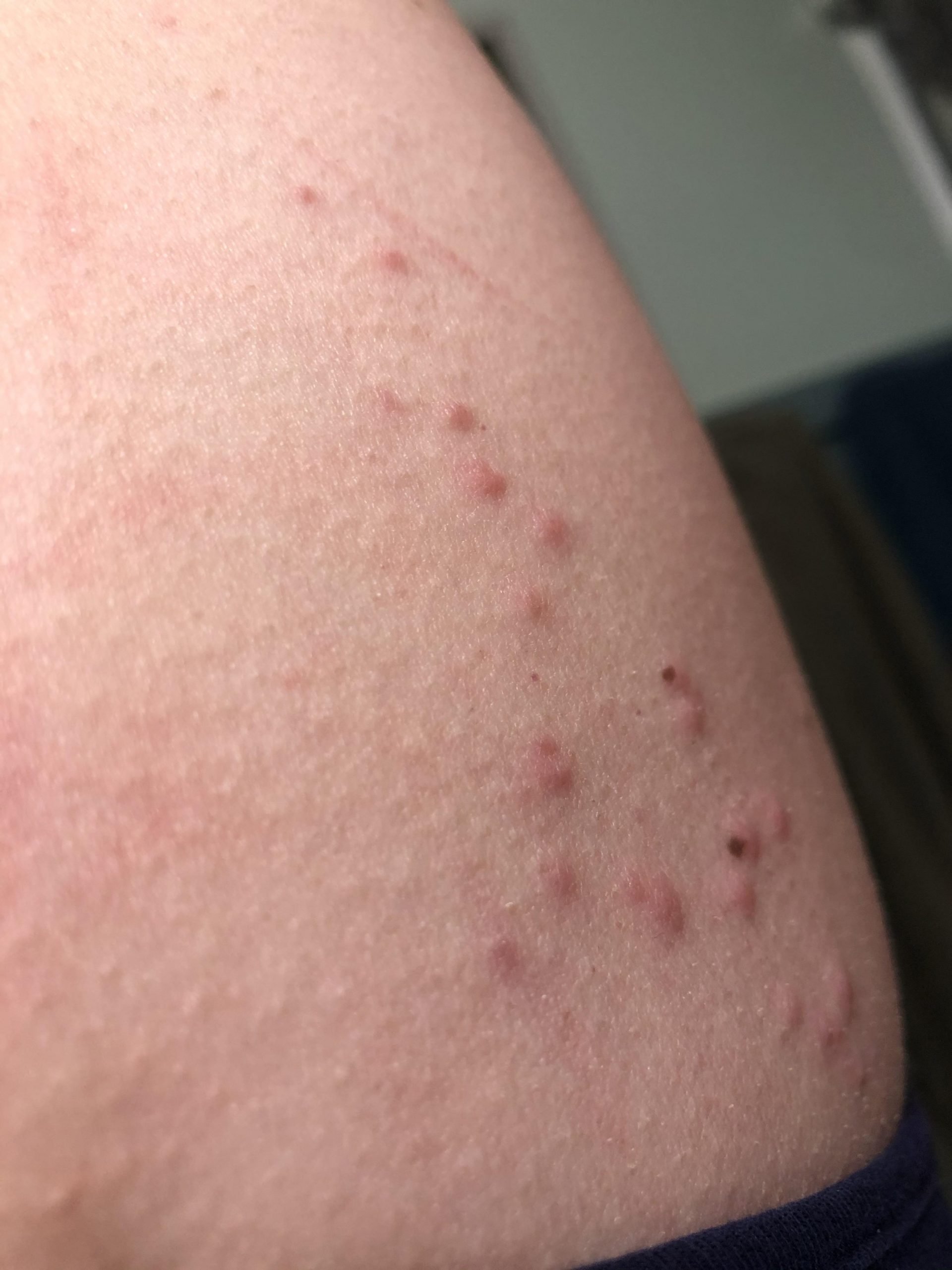 Shingles or bites? : Dermatology