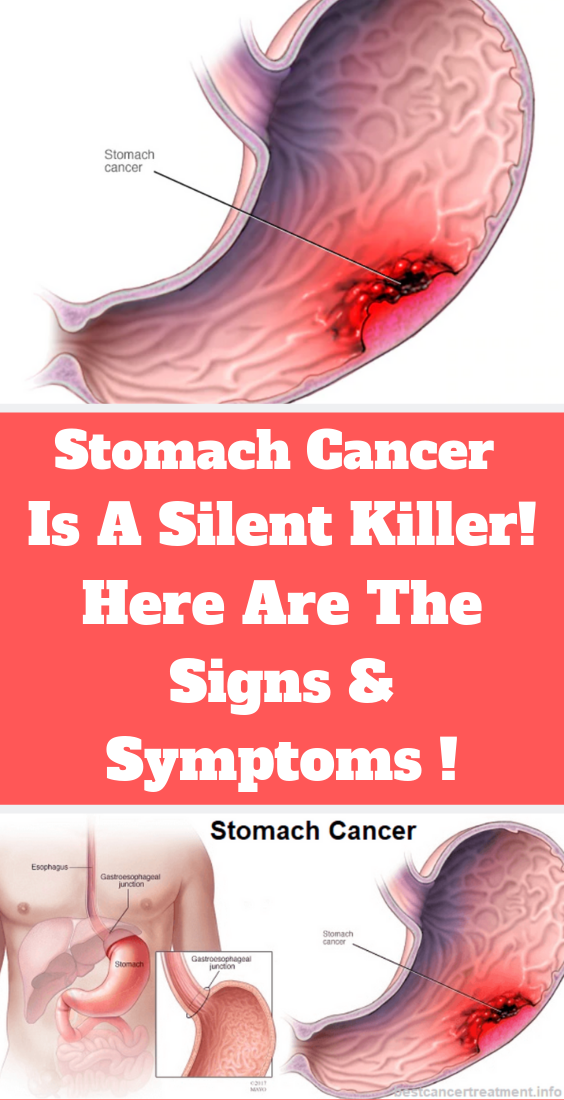 Signs And Symptoms of Stomach Cancer !