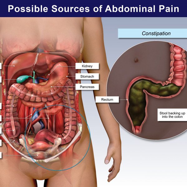 Possible Sources of Abdominal Pain: Constipation ...