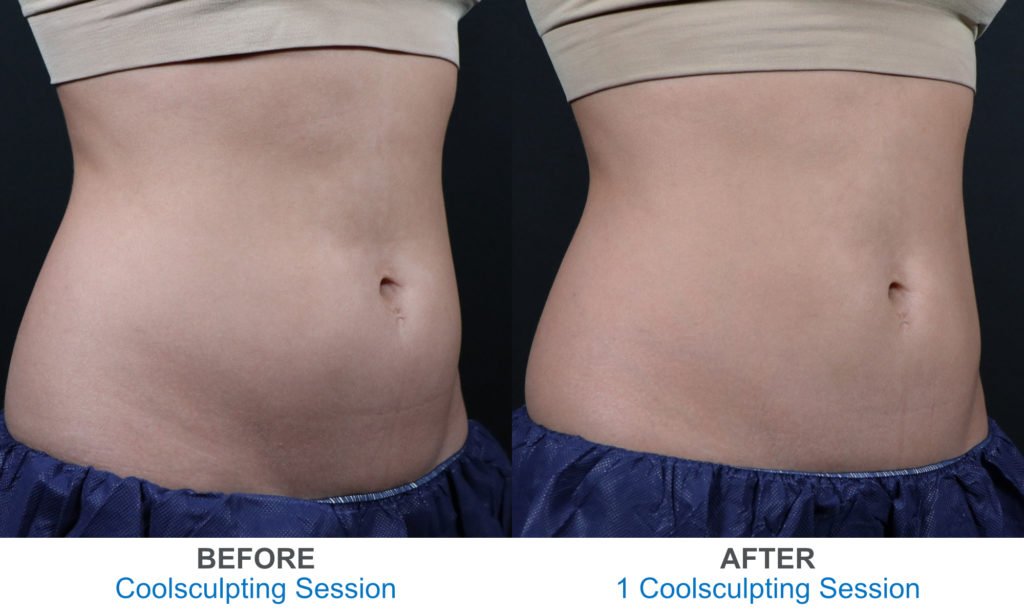 Get An Even Flatter Tummy with Coolsculpting in San Diego, CA