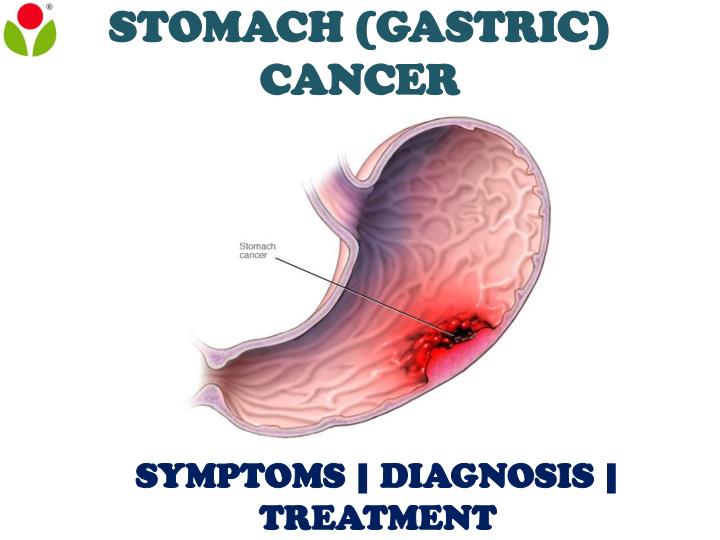 How Do You Know You Have Gastric Cancer