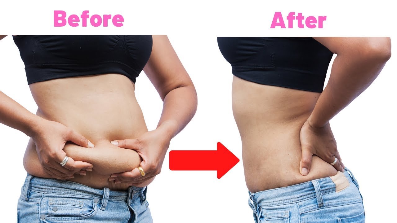 How to Get Rid of Hanging Belly After C Section : Get Flat Stomach in ...