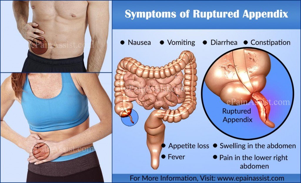 Tricky Symptoms of Appendicitis You Might Never Expected ...
