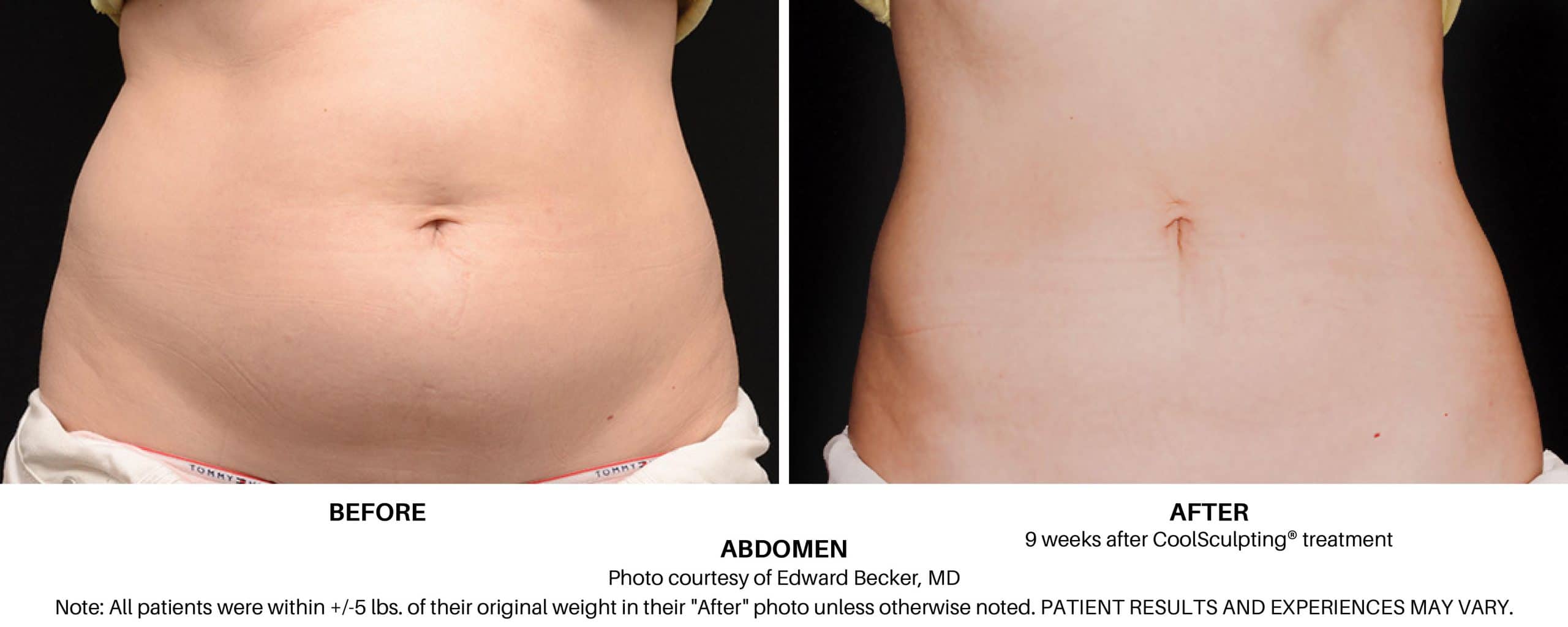 CoolSculpting Elite Before and After Pictures
