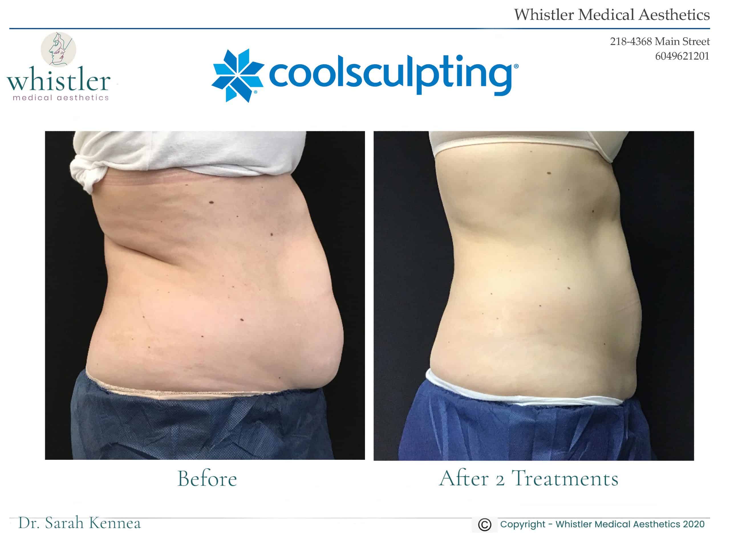 Does Coolsculpting work?