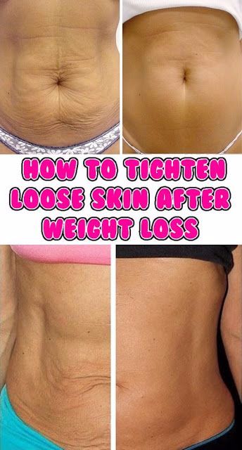 Fitness And Beauty: How to Tighten Loose Skin After Weight Loss