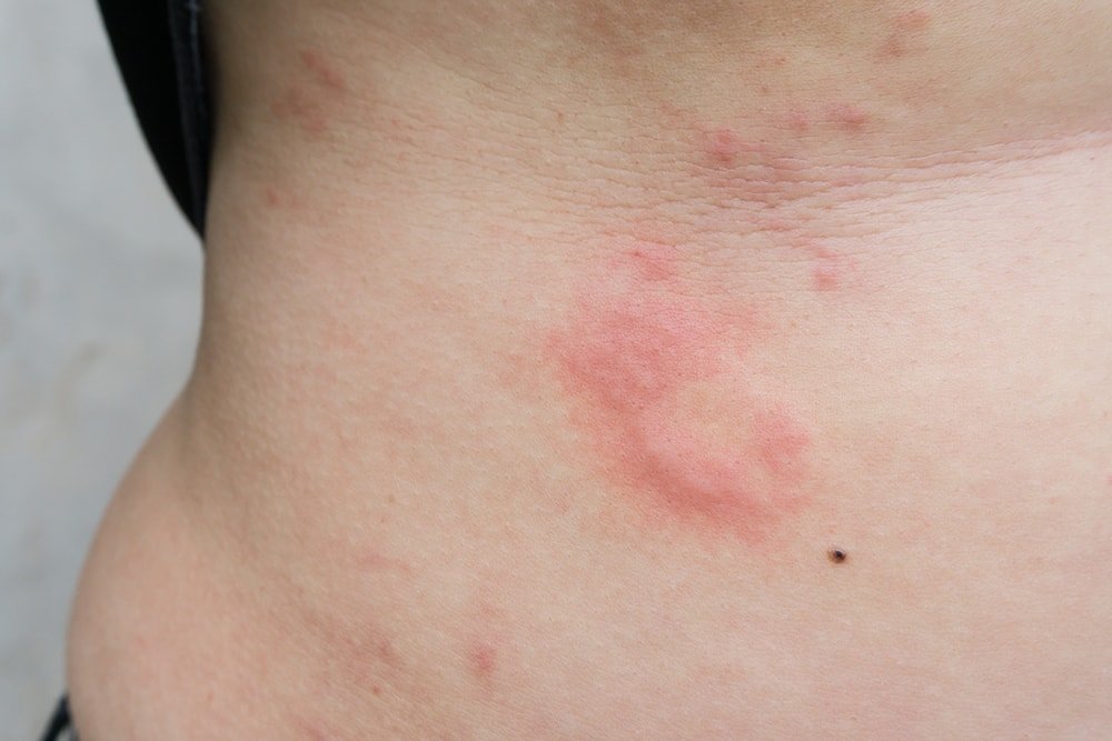 How to Get Rid of Hives with Home Remedies