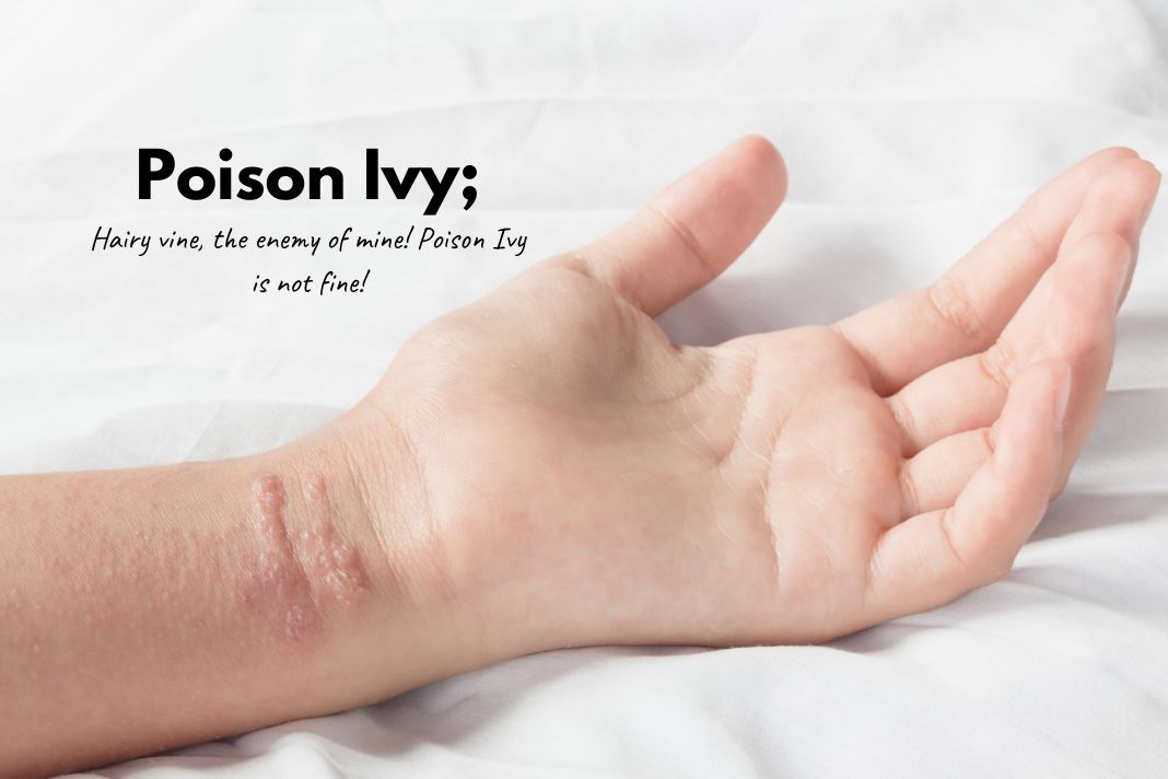 How To Get Rid Of Poison Ivy Rash