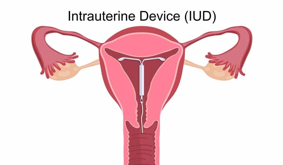Intrauterine Device (IUD): Types, Methods &  Effectiveness