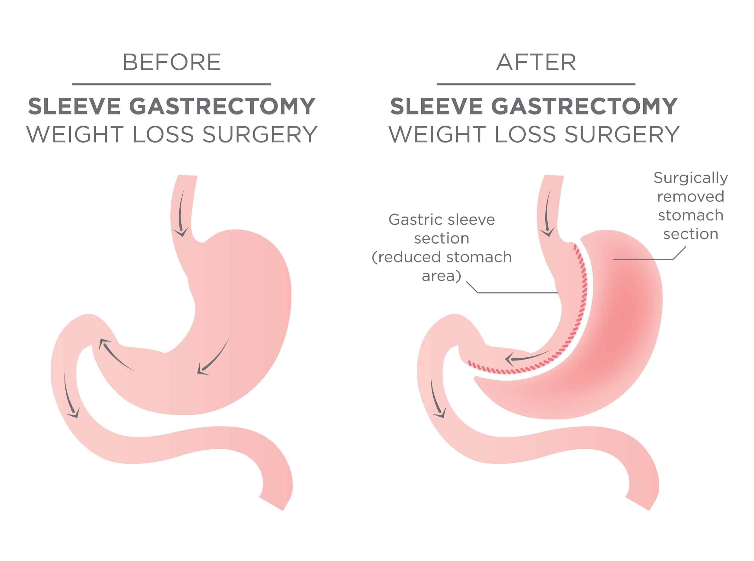 Is Gastric Sleeve Surgery The Right Choice For Me?