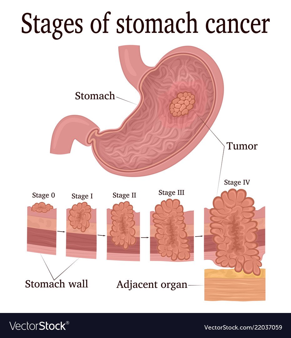 Stages stomach cancer Royalty Free Vector Image