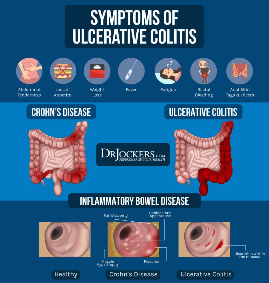 Ulcerative Colitis: Causes, Symptoms and Natural Support Strategies ...
