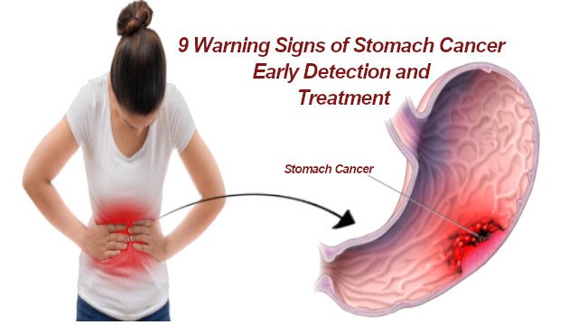 9 Warning Signs of Stomach Cancer Early Detection and Treatment