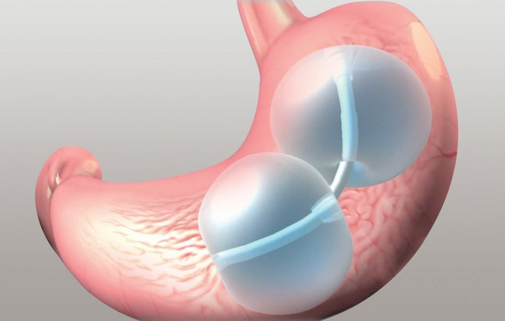 How much gastric balloon cost?
