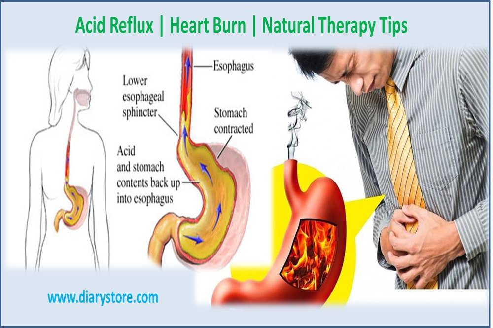 How Should you Sleep if you have Acid Reflux?