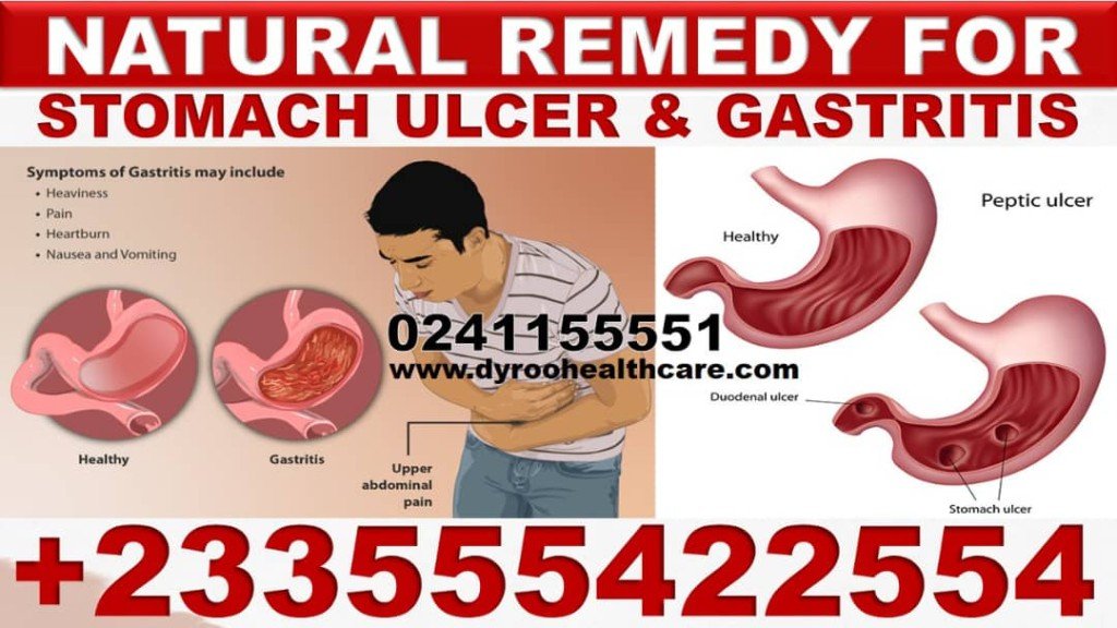 NATURAL TREATMENT FOR PEPTIC ULCER IN GHANA
