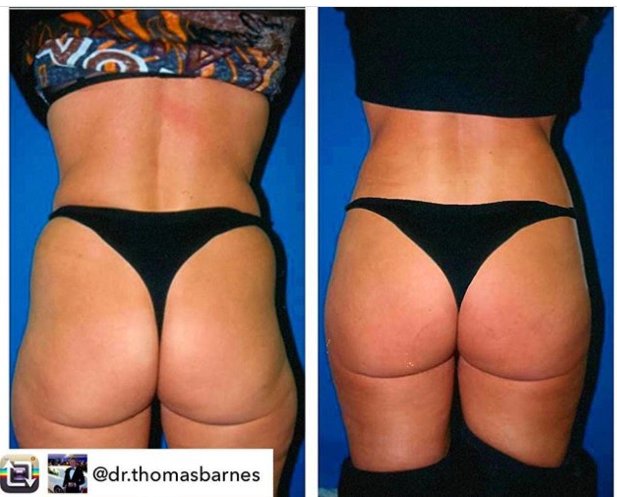 Repost from @dr.thomasbarnes My Brazilian Butt Lift procedure by fat ...