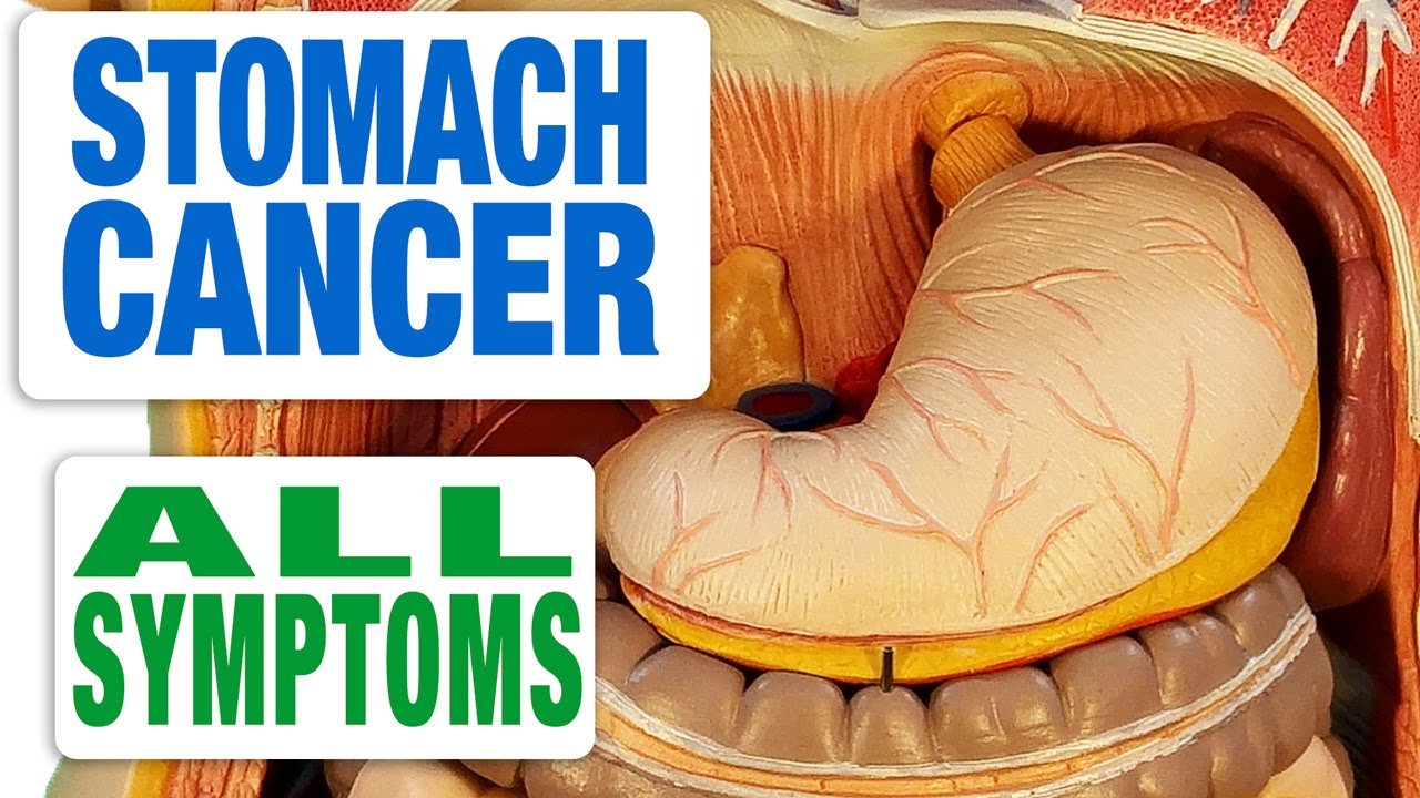 What Does A Cancer Lump Feel Like In Stomach