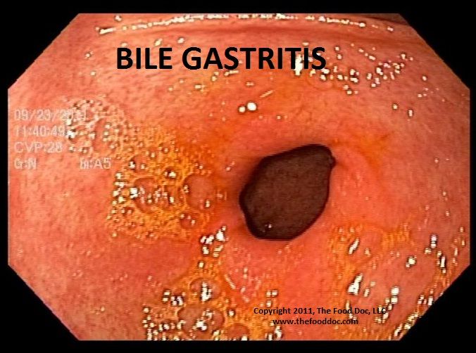 17 Best images about Gastritis on Pinterest