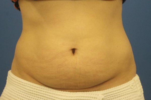 Coolsculpting, Does it work, Cost, Before and After
