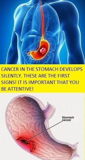 precious health : CANCER IN THE STOMACH DEVELOPS SILENTLY. THESE ARE ...