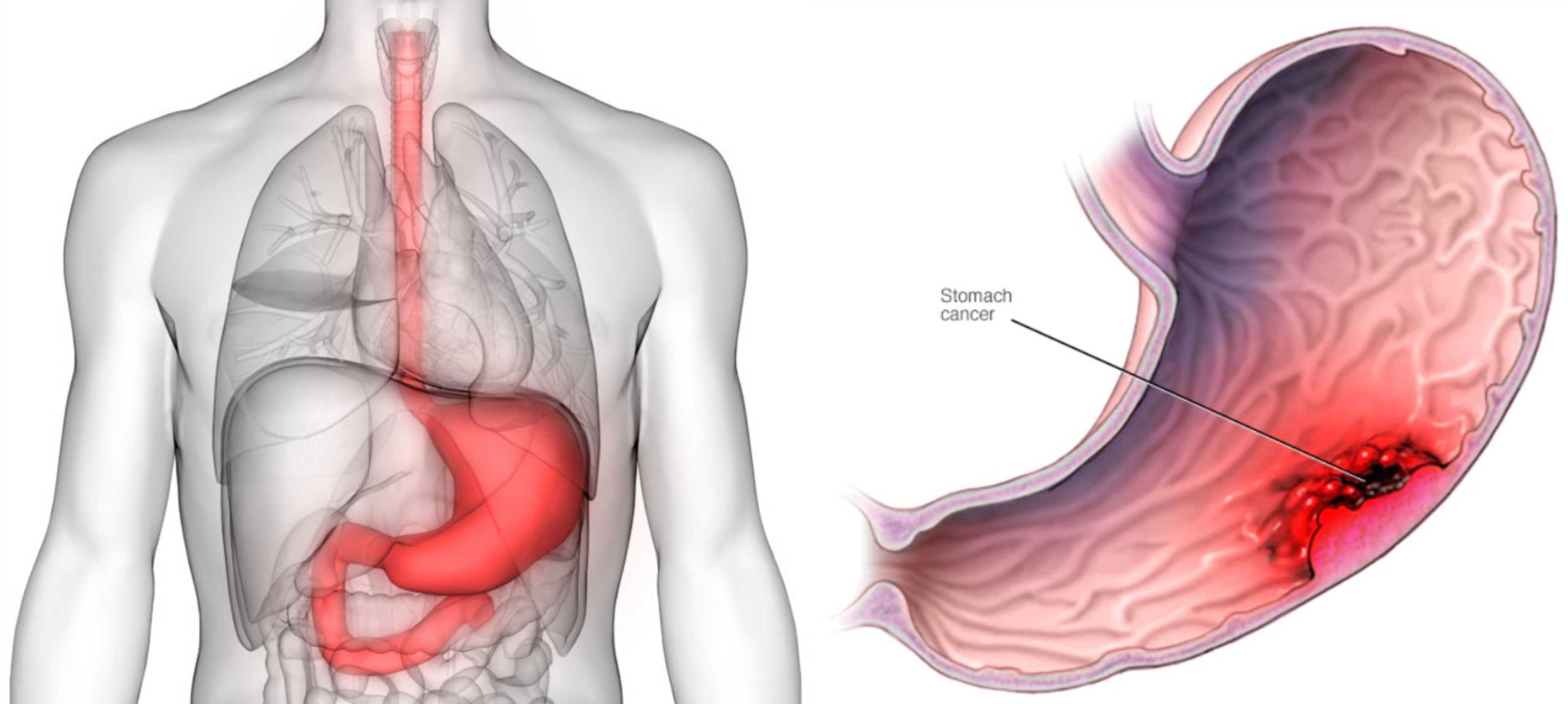 Stomach Cancer? What you need to know!