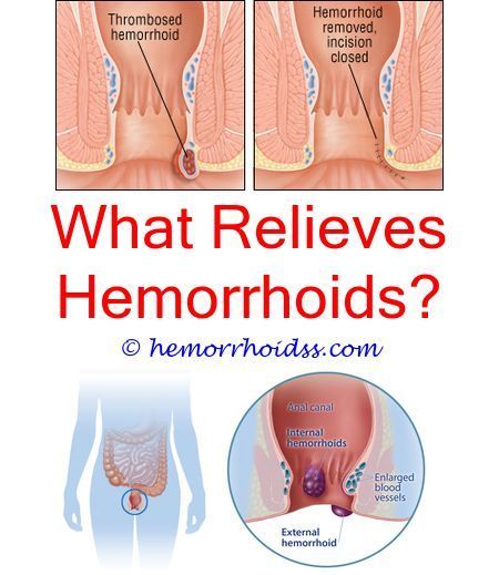 Can i go to a walk in clinic for hemorrhoids?.Why do my hemorrhoids ...