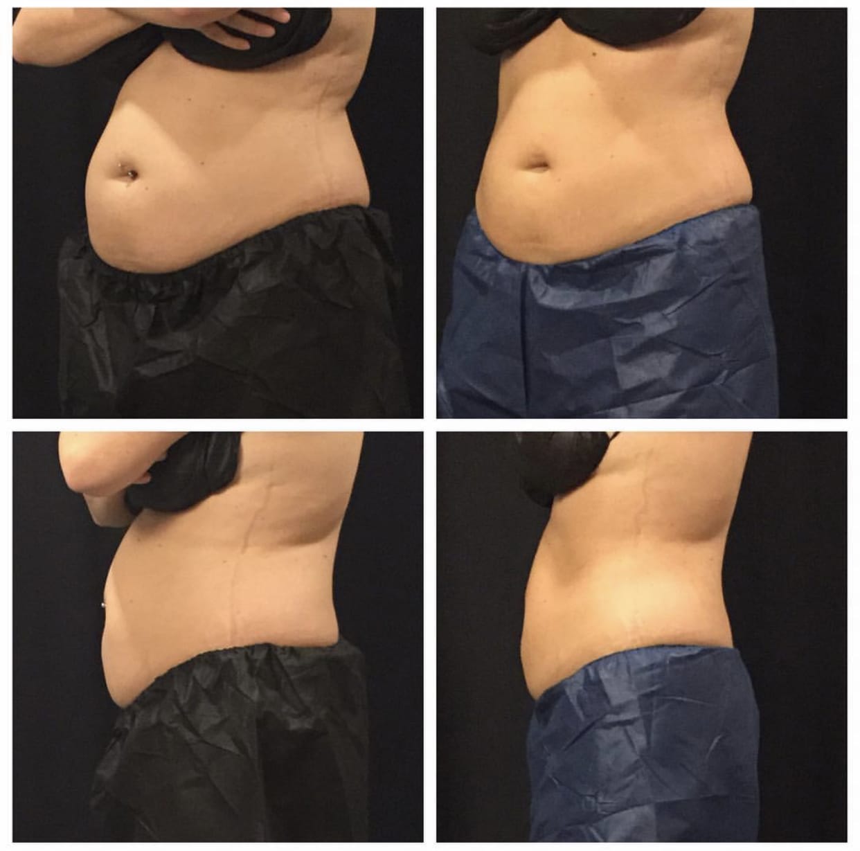 Coolsculpting â Accent Aesthetics â Home of Coolsculpting in South Jersey