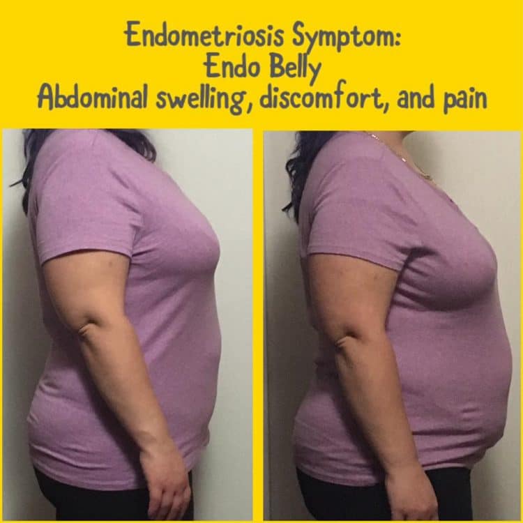 Endometriosis Belly