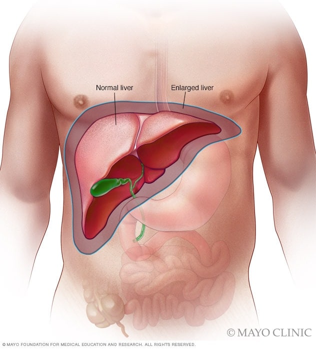 Enlarged liver