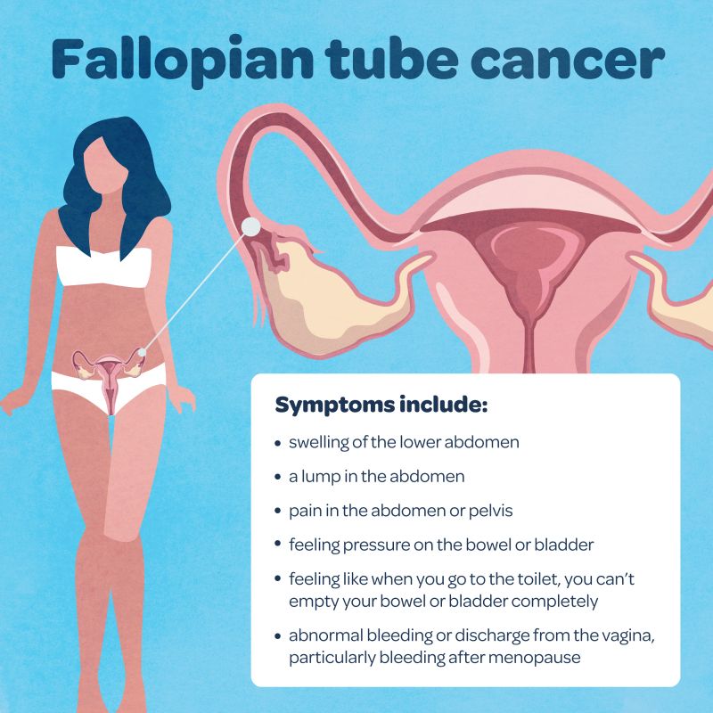 Fallopian Tube Cancer Statistics, Symptoms, Treatment &  Prevention ...