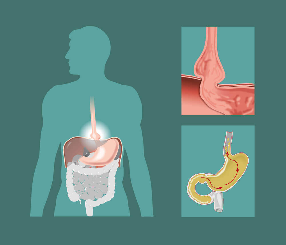 Hiatal Hernia: Causes and Natural Remedies to Treat It