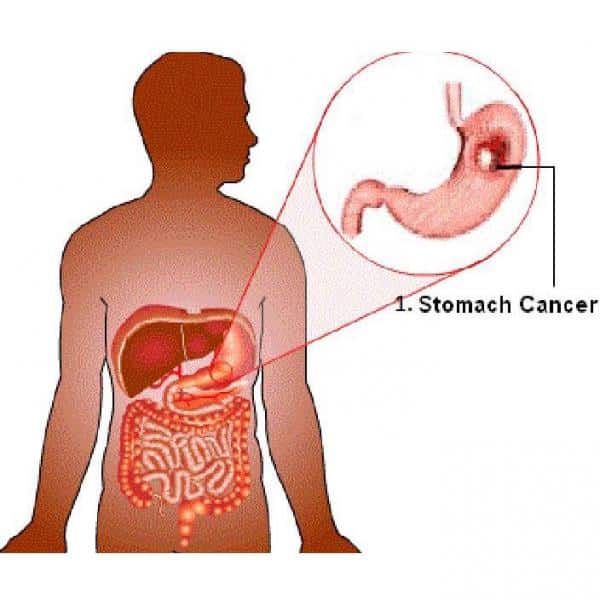 How Do You Know You Have Gastric Cancer : Stomach Cancer Possible ...