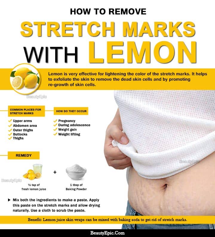 How to Remove Stretch Marks Fast with Lemon