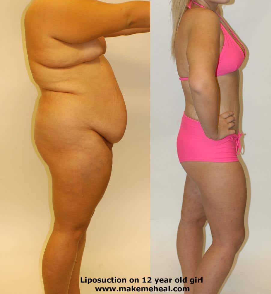 Liposuction Cost : How much and how to evaluate ? ~ The Healthy Tips ...