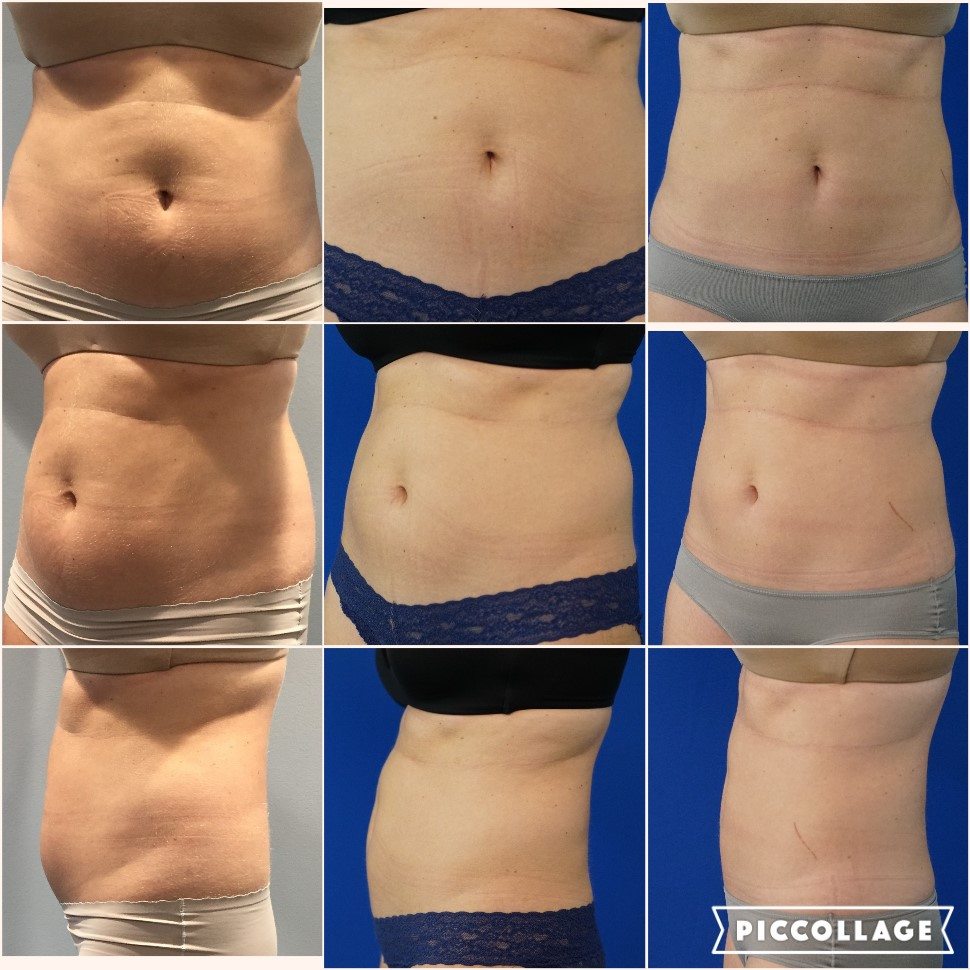 My CoolSculpting Journey