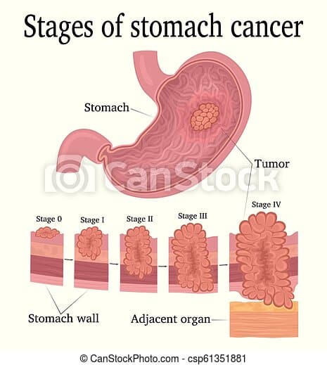 Stages of stomach cancer. Stages of development of a malignant tumor ...