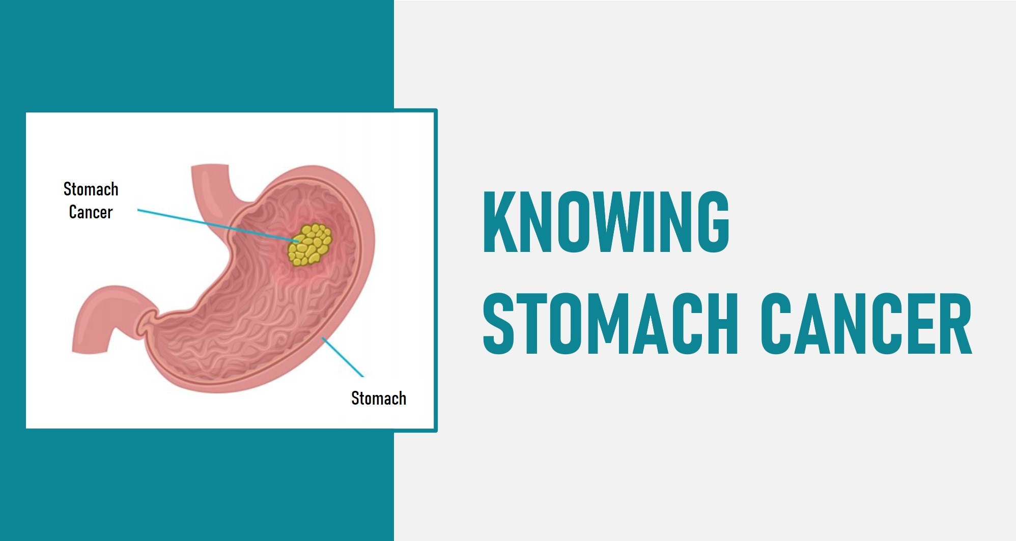 Stomach Cancer (Gastric Cancer)  Causes, Symptoms &  Treatments