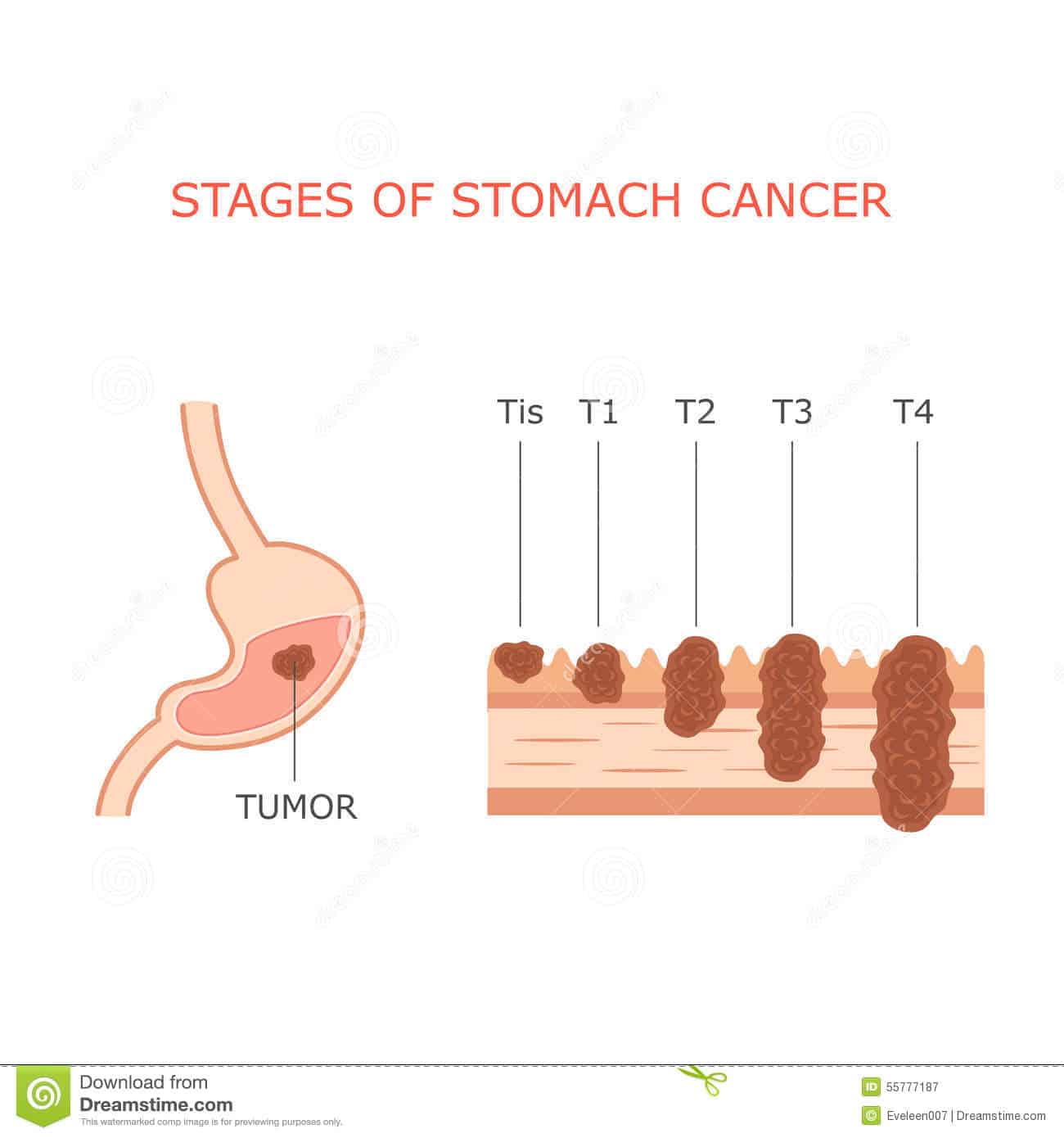 Stomach cancer stages, stock vector. Illustration of health