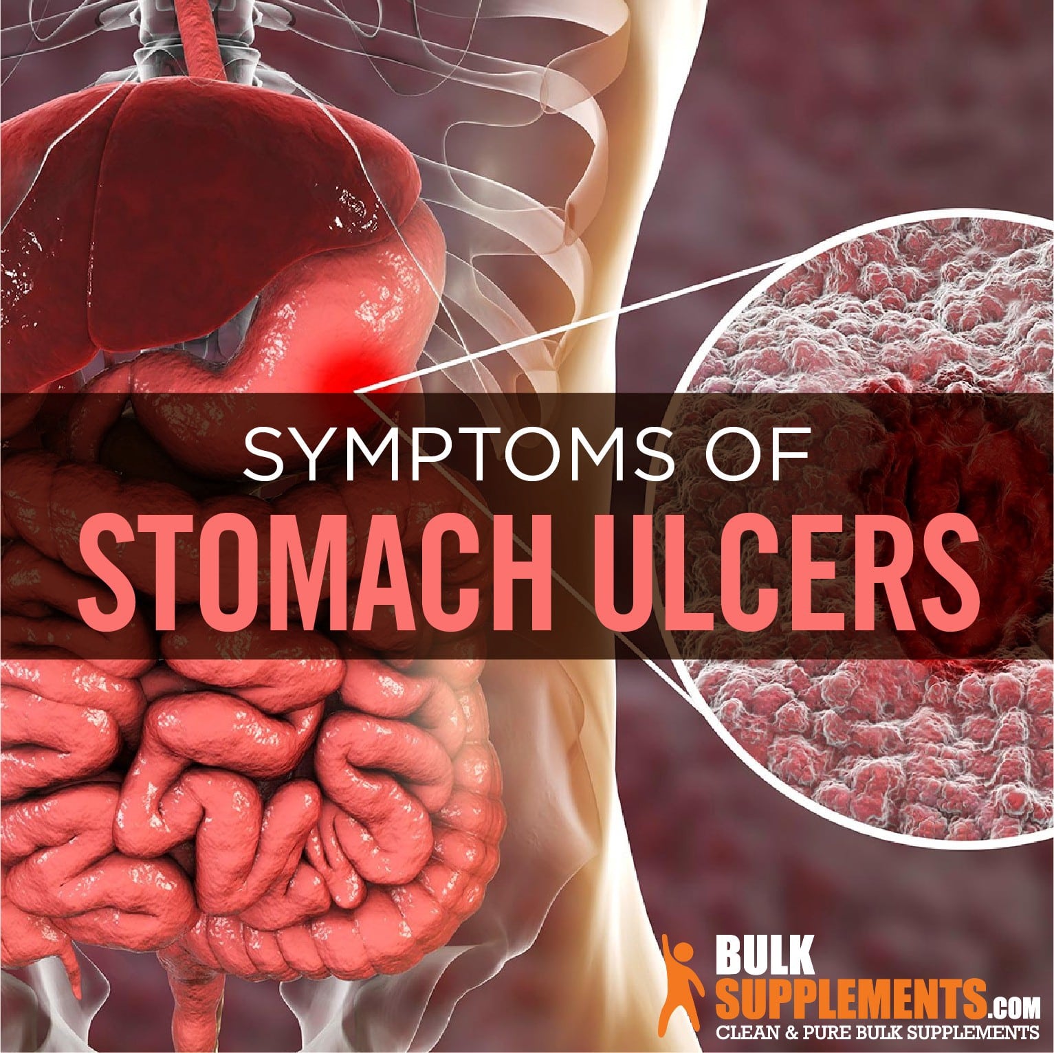 Stomach Ulcers: Causes, Symptoms &  Treatment